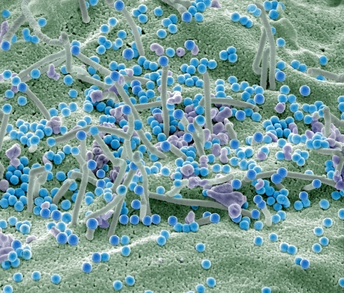HIV infected cell, SEM HIV infected 293T cell. Coloured scanning electron micrograph  SEM  of a 293T cell infected with the human immunodeficiency virus  HIV, cyan dots . Small spherical virus particles, visible on the surface, are in the process of budding from the cell membrane. Any non highlighted vesicles of uneven shape  pale purple  are exosomes, thought to be involved in cell communication and transmission of disease, and under investigation as a means of drug delivery. Because 293T cells have lost their ability to protect themselves from viral infection, something that all cells are normally very good at, 293T are easily transfected, or infected, and can be used to produce large amounts of virus. This makes these cells an extraordinarily valuable tool in medicine and research. Magnification x 20000 at 10cm wide. Specimen courtesy of Greg Towers, UCL