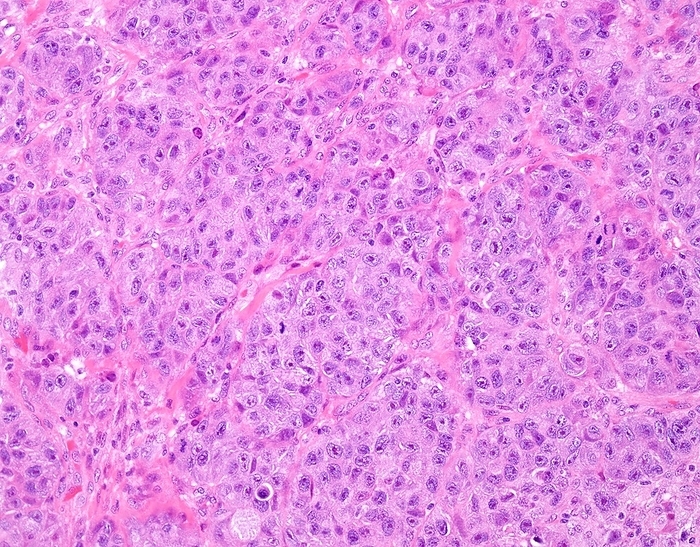 High grade invasive ductal breast cancer, light micrograph High grade invasive ductal breast cancer. Light micrograph of cells in a tissue sample from an invasive ductal breast cancer  malignant tumour . This specimen was assessed for the degree of tubule duct formation  healthy tissue , and was given a score of 3  low  on a scale of 1 3. The tissue forms a solid mass, instead of ducts being visible. This is a high score in terms of cancer, and this was classified as a high grade cancer. Breast cancer is the most common cancer in women. Symptoms include painless lumps in the breast, a dark discharge from the nipple, and an indentation of the nipple. Early diagnosis can be made by mammography or self examination. Once a cancer has spread, the prognosis is poor.