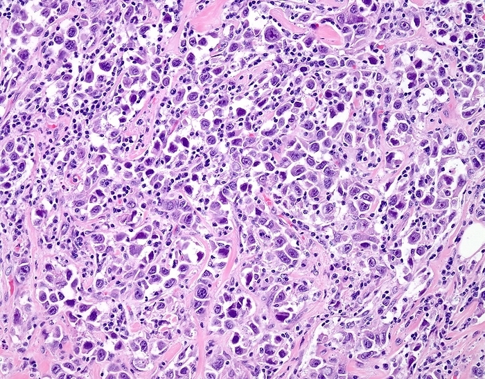 Pleomorphic lobular breast cancer, light micrograph Pleomorphic lobular breast cancer. Light micrograph of a tissue sample from a form of invasive lobular breast cancer. This type of breast cancer arises in milk producing glands  lobules  of the breast. This aggressive form is known as pleomorphic lobular carcinoma  PLC . The cells have irregular hyperchromatic nuclei, prominent nucleoli, and increased mitotic activity. Scattered lymphocytes are present among the tumour cells. Breast cancer is the most common cancer in women. Symptoms include painless lumps in the breast, a dark discharge from the nipple, and an indentation of the nipple. Early diagnosis can be made by mammography or self examination. Once a cancer has spread, the prognosis is poor.