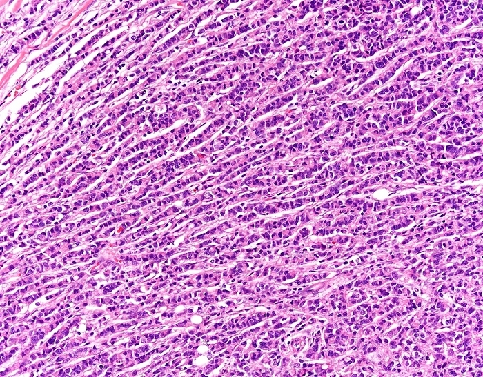 Invasive lobular breast cancer, light micrograph Invasive lobular breast cancer. Light micrograph of a tissue sample from an invasive lobular breast cancer. This type of breast cancer arises in milk producing glands  lobules  of the breast. Classic or pure invasive lobular carcinoma shows tumour cells arranged in strands one to two cells across. Breast cancer is the most common cancer in women. Symptoms include painless lumps in the breast, a dark discharge from the nipple, and an indentation of the nipple. Early diagnosis can be made by mammography or self examination. Once a cancer has spread, the prognosis is poor.