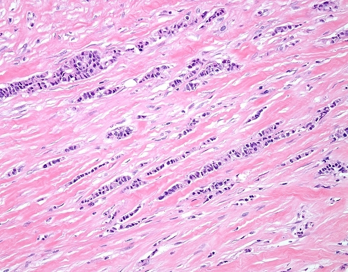 Invasive lobular breast cancer, light micrograph Invasive lobular breast cancer. Light micrograph of a tissue sample from an invasive lobular breast cancer. This type of breast cancer arises in milk producing glands  lobules  of the breast. Classic or pure invasive lobular carcinoma shows absence of solid, alveolar, papillary, or gland forming units. The tumour cells are usually arranged in slender linear strands one to two cells across, along with a fibrotic stroma. Breast cancer is the most common cancer in women. Symptoms include painless lumps in the breast, a dark discharge from the nipple, and an indentation of the nipple. Early diagnosis can be made by mammography or self examination. Once a cancer has spread, the prognosis is poor.