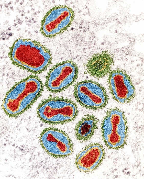 Smallpox viruses Smallpox viruses. Coloured Transmission Electron Micrograph  TEM  of a section through many Variola major viruses. These agents cause smallpox. The protein coat of each virus is coloured green  DNA genetic material is red. The viruses display a complex symmetry. Smallpox is a disease which, by 1980, was eradicated by vaccination. The disease causes high fever and skin spots that quickly develop into scarring pustules. The virus is transmitted by coughed droplets or the pus from pustules of an infected person. Up to 40  of smallpox victims died due to complications such as pneumonia. The virus is now used for purposes of research. Magnification: x28,500 at 6x7cm size.