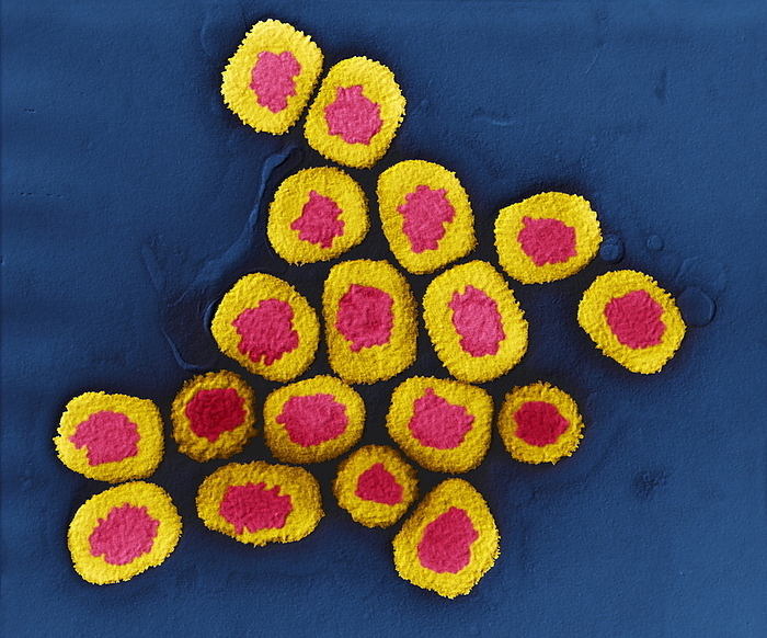 Smallpox viruses, TEM Smallpox viruses. Coloured transmission electron micrograph  TEM  of variola viruses, the cause of smallpox. The virus consists of genetic material  red , DNA  deoxyribonucleic acid , enclosed by a protein capsid  coat, yellow . Variola is the most virulent member of the orthopoxvirus group. It is specific to humans, having no other animal hosts. Infection with variola causes a high temperature and skin spots that develop into scarring pustules. It is transmitted by respiratory droplets or by the pus. Smallpox was eradicated in the 1970 s by a global vaccination programme. However, isolated cultures of the virus are still kept in laboratories for research purposes. Magnification: x63000 when printed 10 cm wide.