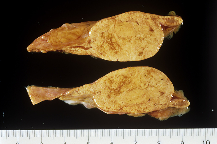 Adrenal gland tumour Adrenal gland tumour, gross specimen. This is an adenoma of the cortex  outer lining  of the adrenal gland. Although benign  non cancerous , the growth can cause problems as it may lead to over  or under production of the hormone cortisol  hydrocortisone , which the gland produces and secretes. Cortisol is responsible for regulating stress and energy levels. The immune and inflammatory response is also mediated to a large extent by its release. Over production of cortisol leads to Cushing s Syndrome, which causes weight gain, muscle weakness, high blood pressure and psychological disturbances. In such cases, the gland is usually removed.