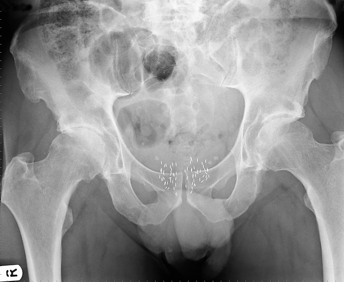 Osteoarthritis of the hip, X ray Osteoarthritis. X ray of the pelvis of a 65 year old man with moderate osteoarthritis in the right hip  seen at left  and mild osteoarthritis in the left hip  right . The ball at the top of the femur  thigh bone  fits into the socket of the hip. Normally, there is a clear space between the ball and socket, but here there is little or no space. Osteoarthritis results in the loss of cartilage between the joint. The healing process leads to the growth of bone in place of the cartilage, causing pain, stiffness and loss of mobility. The white specks  lower centre  may be radioactive rods implanted around a cancerous prostate gland or bladder, a method of radiotherapy known as brachytherapy.