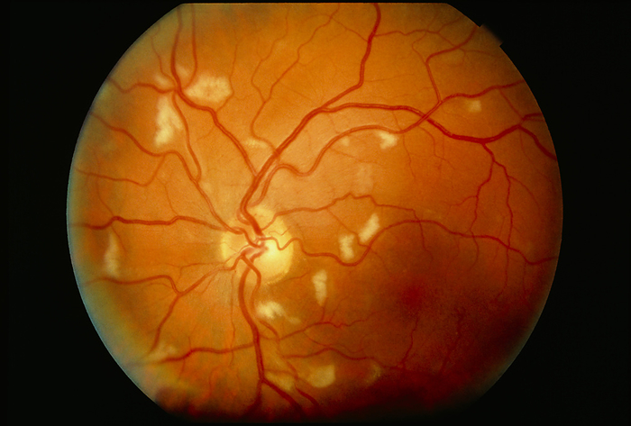 Ophthalmoscopy of CMV retinitis in AIDS patient CMV retinitis in AIDS. Ophthalmoscope view of the retina of an AIDS patient, showing the damage resulting from cytomegalovirus  CMV  infection. The virus causes inflammation of the blood vessels  vasculitis , leading to areas of infarction  dark patches, at lower right  in which cell death results from a cessation of blood supply. White cotton wool areas represent deposition of fatty exudates as well as reduced blood flow. CMV retinitis is the most common eye disorder in AIDS  Acquired Immune Deficiency Syndrome   it may progress rapidly to irreversible blindness. Treatment may include the use of antiviral drugs such as acyclovir.