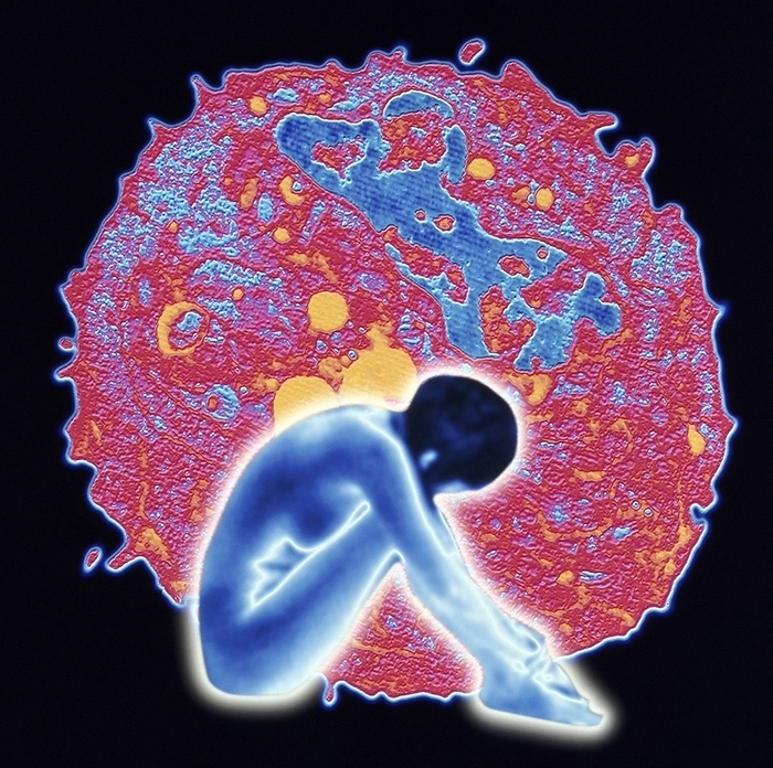Computer artwork of woman and breast cancer cell Breast cancer. Computer artwork of a naked woman sitting before an electron micrograph of a single breast cancer cell. The uneven clumps and cytoplasmic projections of the cancer cell are clearly seen. Malignant breast cancer cells can form tumours which grow and spread throughout body as secondary tumours. Breast cancer is the most common cancer in women. Symptoms of breast cancer include painless lumps appearing in the breast, a dark discharge from the nipple, and an indentation of the nipple. Surgical removal of affected areas is often required.