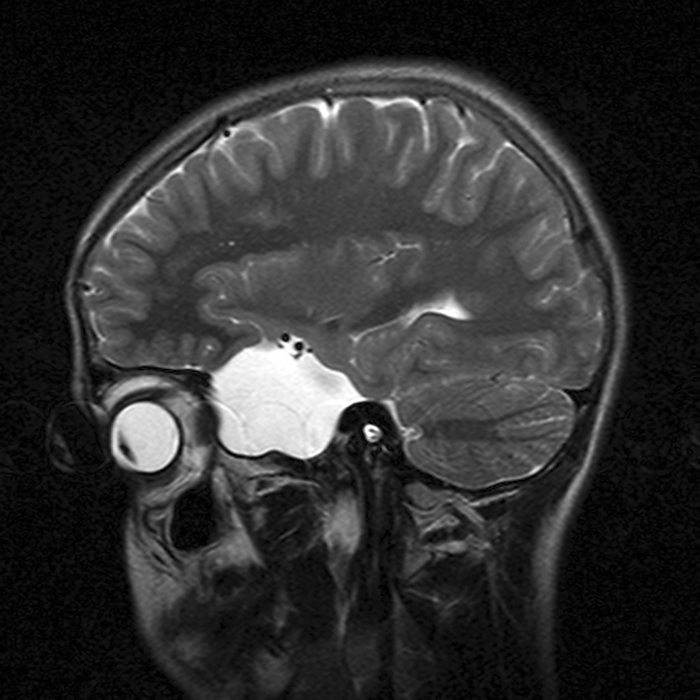 Arachnoid Cyst, MRI scan Arachnoid cyst. Magnetic resonance imaging  MRI  scan of a sagittal  side  section through the brain of a 13 year old boy. The front of the head is at left. The scan shows a large left middle cranial fossa arachnoid cyst  white . This is an abnormal collection of CSF  cerebral spinal fluid , which is walled off and acts like a mass. It is benign but can cause a variety of symptoms including seizures. MRI uses radio waves and a magnet to obtain  slice   body images. 