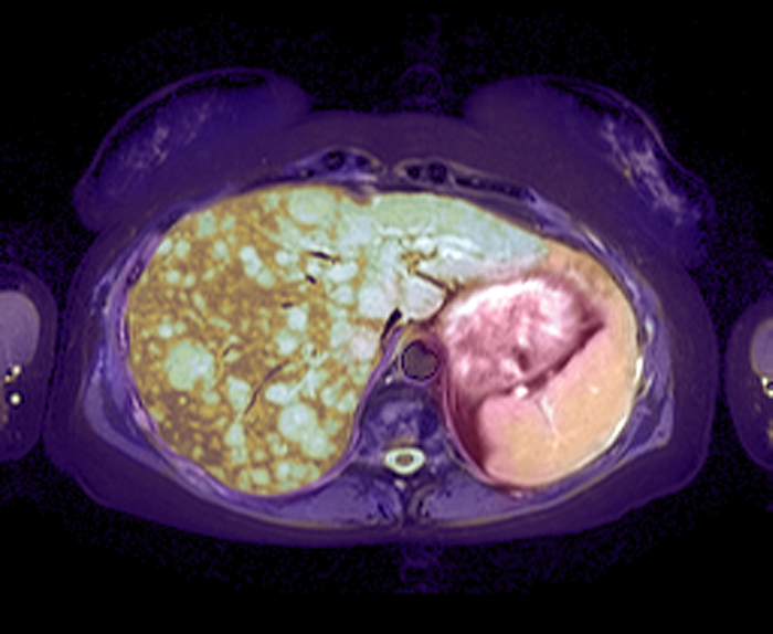 Liver cancer, MRI scan Liver cancer. Coloured magnetic resonance imaging  MRI  scan of an axial  horizontal  section through the abdomen of a 42 year old woman. The front of the body is at top. Tumours can be seen  pale green  throughout the liver  brown, left , resulting from secondary liver cancer, metastasized  spread  from cancer of the breast. All malignant tumours have the capacity to metastasize. The commonest malignant growths found in the liver do in fact arise from cancers in other organs. Once a cancer has spread beyond its site of origin, the prognosis is poor.