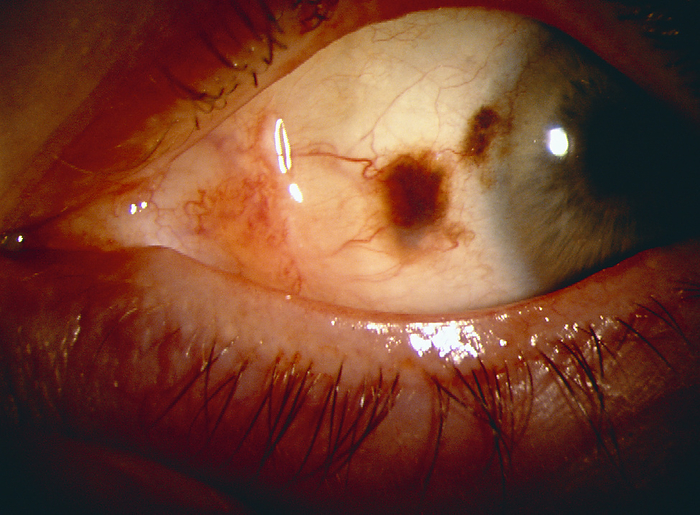 Eye cancer Eye cancer. Malignant  cancerous  melanoma tumour  dark patch at upper centre  in the conjunctiva of the eye. The conjunctiva is the clear membrane covering the surface of the eye. Although the tumour has no effect on vision here, the tumour is likely to grow, causing blurred or double vision and eventual vision loss. Treatment includes surgically removing the tumour, radiotherapy, chemotherapy, plaque therapy and laser therapy.