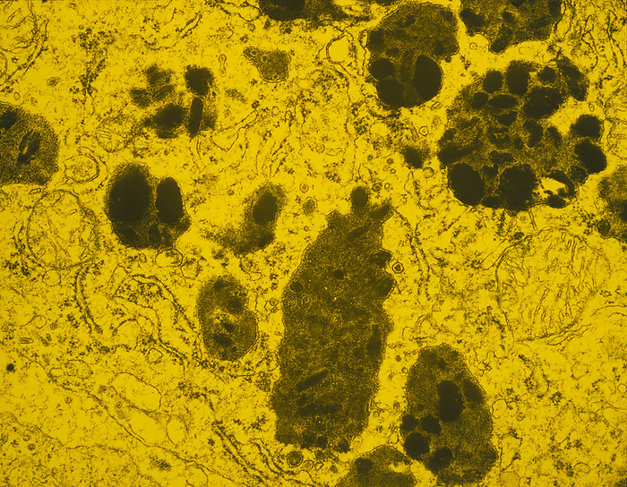 Tinted TEM of melanin in malignant melanoma False colour transmission electron micrograph  TEM  showing melanin over production in a heavily pigmented human malignant melanoma that has spread  metastasised  to a lymph node. Melanin appears as the dense, dark patches in the image. Malignant melanoma is an aggressive cancer of the melanocytes, the pigment producing cells of skin. Magnification: x3,845 at 35mm size.