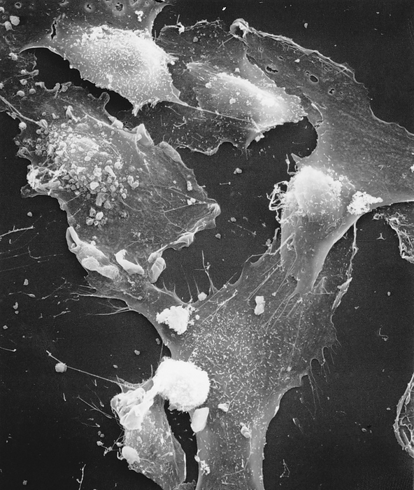 Cancer cells in Hodgkin s disease Scanning electron micrograph of Hodgkin s cells taken from the pleural effusions of a 55 year old, male patient with  mixed cellularity Hodgkin s Disease  . The cells are grown in tissue culture. Hodgkin s disease is a cancer of the lymphoreticular system   the mediator of non  specific cell defence mechanisms   the immune response. The various cell lines of the system are all subject to cancerous changes. In Hodgkin s disease, the nature of the cell line is unknown, but in the most common form the cell population is mixed. Magnification: x800 at 8x10 inch size. 