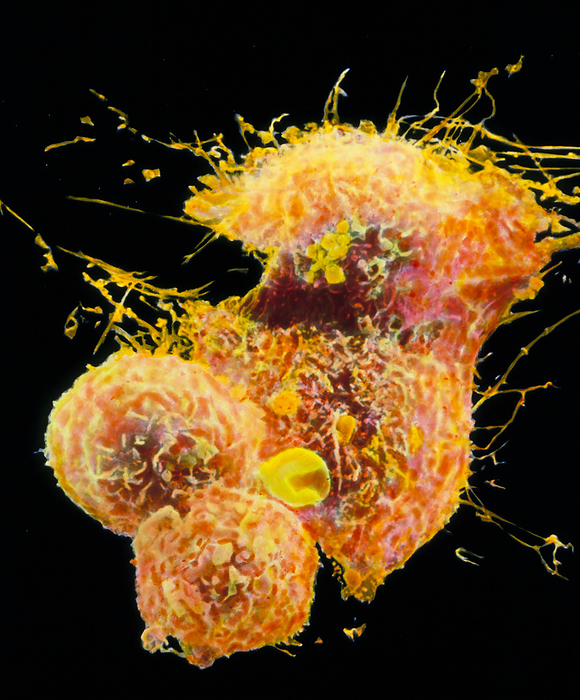 Coloured SEM of Hodgkin s cells Hodgkins disease. Coloured scanning electron micrograph of dividing Hodgkin s cells taken from the pleural effusions of a 55 year old, male patient with  mixed cellularity Hodgkin s disease  . The cells are grown in tissue culture. Hodgkin s disease is a cancer of the lymphoreticular system   the mediator of non  specific cell defence mechanisms   the immune response. The various cell lines of the system are all subject to cancerous changes. In Hodgkin s disease, the nature of the cell line is unknown, but in the most common form the cell population is mixed. Magnification: x572 at 6x7cm size. magnification: x2,000 at 8x10 inch size. 
