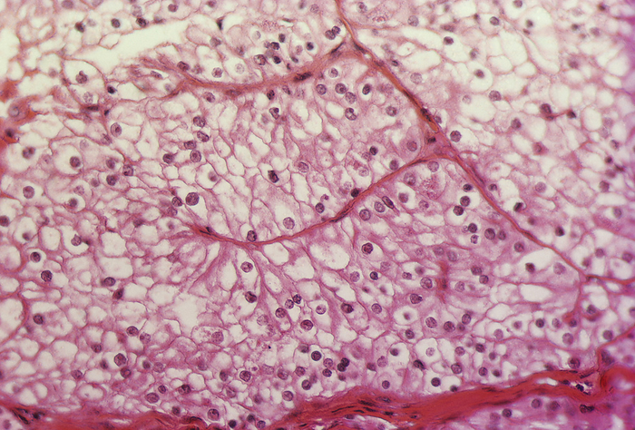 Kidney cancer Kidney cancer. Light micrograph of a section through an adenocarcinoma in kidney tissue. Cell nuclei are stained dark purple. A carcinoma is a cancer that arises in epithelial tissue. An adenocarcinoma arises from glandular epithelial tissue. The majority of cancers of the kidney are renal cell carcinomas that present few symptoms and resist radiotherapy and chemotherapy. If still localized, the tumour is surgically removed. If it has spread  metastasised , then chemotherapy will be required. Magnification unknown.