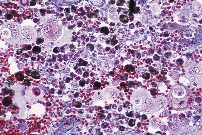 Brain tumour Brain tumour. Light micrograph of a section of a secondary brain tumour, caused by the spread  metastasis  of a skin cancer  malignant melanoma  to brain tissue. The cancer cells are black due to the melanin pigment they produce. The main risk factor for malignant melanoma is exposure to ultraviolet  UV  light from the sun or sunbeds. It may rarely be the result of an inherited gene defect. Metastasis to the central nervous system occurs in about a quarter of cancer cases. Aside from melanoma, types which often spread to the brain include kidney, liver and lung cancer. Treatment is usually surgery, radiation or a combination of the two. Magnification unknown.
