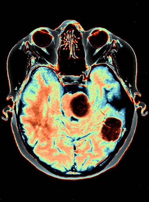 Brain cancer, MRI Brain cancer. Coloured magnetic resonance imaging  MRI  scan of an axial section through a patient s head showing two secondary brain tumours  dark areas at centre and lower right . The front of the head is at top. These tumours have spread  metastasised  from a malignant melanoma, a form of skin cancer. Malignant melanomas arise from cells  melanocytes  in the skin that produce the pigment melanin. The risk of developing melanoma is increased by excessive exposure to sunlight. Malignant melanomas invade and destroy surrounding tissues and often spread. Treatment is by excision of the primary tumour, with radiotherapy and chemotherapy if the cancer has spread.