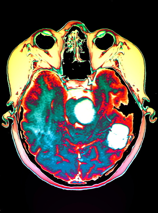 Brain cancer, MRI Brain cancer. Coloured magnetic resonance imaging  MRI  scan of an axial section through a patient s head showing two secondary brain tumours  white, centre and lower right . The front of the head is at top. These tumours have spread  metastasised  from a malignant melanoma, a form of skin cancer. Malignant melanomas arise from cells  melanocytes  in the skin that produce the pigment melanin. The risk of developing melanoma is increased by excessive exposure to sunlight. Malignant melanomas invade and destroy surrounding tissues and often spread. Treatment is by excision of the primary tumour, with radiotherapy and chemotherapy if the cancer has spread.