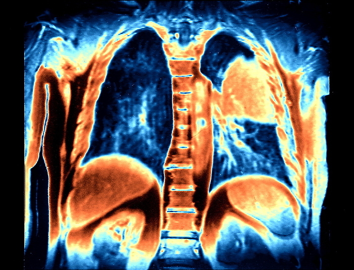 Lung cancer, MRI Lung cancer. Coloured magnetic resonance imaging  MRI  scan of a coronal  frontal  section through a patient s chest, showing a malignant tumour  orange, upper right  in the left lung. Cancer cells divide rapidly and chaotically. They may clump to form tumours  as seen here , which invade and destroy surrounding tissues. Lung cancer causes a cough, chest pain, shortness of breath and weight loss. If the cancer has not spread  metastasised  to other tissues then the tumour may be removed surgically. Other treatments include chemotherapy  anti cancer drugs  and radiotherapy.