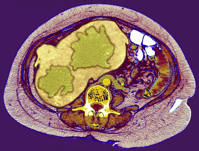 Liver cancer, CT scan Liver cancer. Coloured axial computed tomography  CT  scan through a cancerous liver  browm, upper left . This patient, a 45 year old woman, has a large hepatocellular carcinoma  green  within the liver. This slice section is seen from below with the front of the body at top and the spine  green yellow  at lower centre. The liver is the largest gland in the body, and has many vital roles that include metabolising nutrients and detoxifying the blood. This makes treatment of liver cancer difficult, and the prognosis is poor.