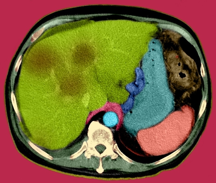 Liver cancer, CT scan Liver cancer. Coloured axial computed tomography  CT  scan through a liver  green, upper left  and secondary  metastatic  liver cancer  brown . This slice section, from a male patient, is seen from below with the front of the body at top and the spine  white  at lower centre. The liver is the largest gland in the body, and has many vital roles that include metabolising nutrients and detoxifying the blood. This makes treatment of liver cancer difficult, and the prognosis is poor.