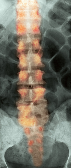 Secondary bone cancer, X ray Secondary bone cancer. Coloured X ray of the spine of a man with sclerotic vertebrae due to metastatic  secondary  cancer. The cancer has caused areas of increased bone density called sclerotic lesions  orange . The cancer spread from a tumour in the prostate gland, part of the male reproductive system located below the bladder. Bone cancer may cause pain, particularly at night, and the bones often have a tendency to fracture. Treatment includes radiotherapy, chemotherapy and hormone therapy.