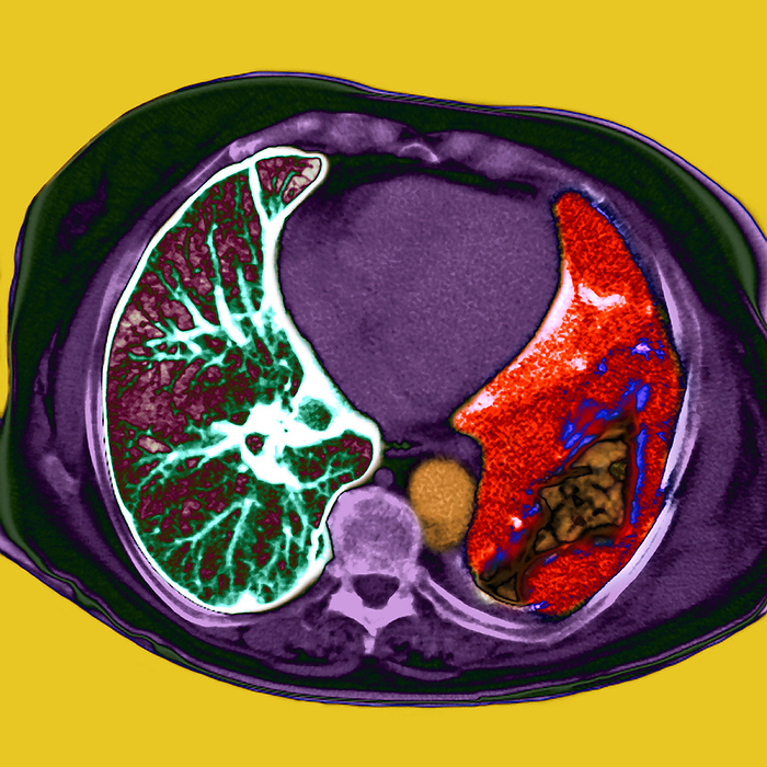 Lung cancer, CT scan Lung cancer. Coloured computed tomography  CT  scan of an axial section through the chest of a patient with a mesothelioma cancer  red . It is surrounding and constricting the lung at right  brown . The other lung  dark pink  has a healthy pleura  white green . The descending aorta  orange , spine  lower centre, light purple  and the heart  dark purple, between lungs  are also seen. Mesothelioma is a malignant cancer of the pleura, the membrane lining the chest cavity and lungs. It is usually caused by asbestos exposure. It often reaches a large size, as here, before diagnosis, and the prognosis is then poor.