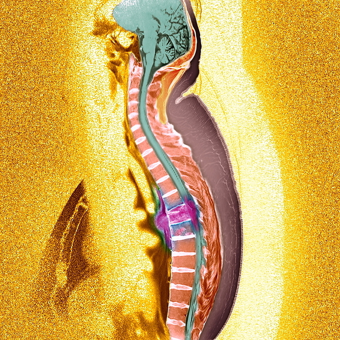 Bone cancer, MRI Bone cancer. Coloured sagittal  side  magnetic resonance imaging  MRI  scan of the thoracic spine of a patient with secondary bone cancer  bright pink, centre . The front of the body is at left. The spinal cord  blue  is to the right of the vertebrae  pink blocks . The cancer has spread  metastasised  from a site of primary cancer. Spread of cancer to the spine is common, it causes severe pain and the bones have a tendency to fracture. The prognosis is very poor. Treatment includes radiotherapy, chemotherapy and hormone therapy.