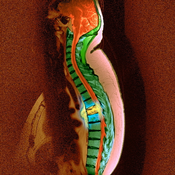 Bone cancer, MRI Bone cancer. Coloured sagittal  side  magnetic resonance imaging  MRI  scan of the thoracic spine of a patient with secondary bone cancer  yellow and blue, centre . The front of the body is at left. The spinal cord  red  is to the right of the vertebrae  green blocks . The cancer has spread  metastasised  from a site of primary cancer. Spread of cancer to the spine is common, it causes severe pain and the bones have a tendency to fracture. The prognosis is very poor. Treatment includes radiotherapy, chemotherapy and hormone therapy.