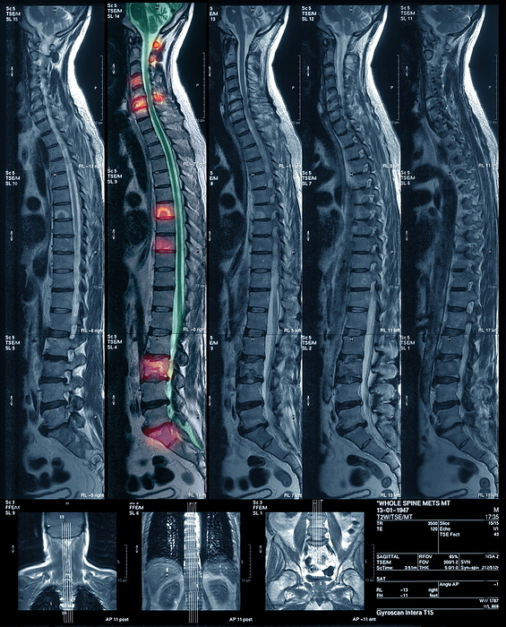 Bone cancer, MRI scan Bone cancer. Coloured magnetic resonance imaging  MRI  scan of a sagittal  side  view through the back of a 57 year old male patient with secondary bone cancer. The vertebrae affected are highlighted red. The spinal cord is on the right of the vertebrae. The cancer has spread  metastasised  from a primary cancer in the lung. Spread of cancer to the spine is common. The prognosis is very poor. Treatments are aimed at preserving function and quality of life. Drugs  steroids  and radiotherapy are used.