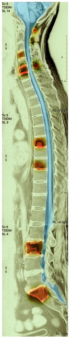 Bone cancer, MRI scan Bone cancer. Coloured magnetic resonance imaging  MRI  scan of a sagittal  side  view through the back of a 57 year old male patient with secondary bone cancer. The vertebrae affected are highlighted orange. The spinal cord is on the right of the vertebrae. The cancer has spread  metastasised  from a primary cancer in the lung. Spread of cancer to the spine is common. The prognosis is very poor. Treatments are aimed at preserving function and quality of life. Drugs  steroids  and radiotherapy are used.