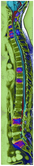 Bone cancer, MRI scan Bone cancer. Coloured magnetic resonance imaging  MRI  scan of a sagittal  side  view through the back of a 57 year old male patient with secondary bone cancer. The vertebrae affected are highlighted purple. The spinal cord is on the right of the vertebrae. The cancer has spread  metastasised  from a primary cancer in the lung. Spread of cancer to the spine is common. The prognosis is very poor. Treatments are aimed at preserving function and quality of life. Drugs  steroids  and radiotherapy are used.