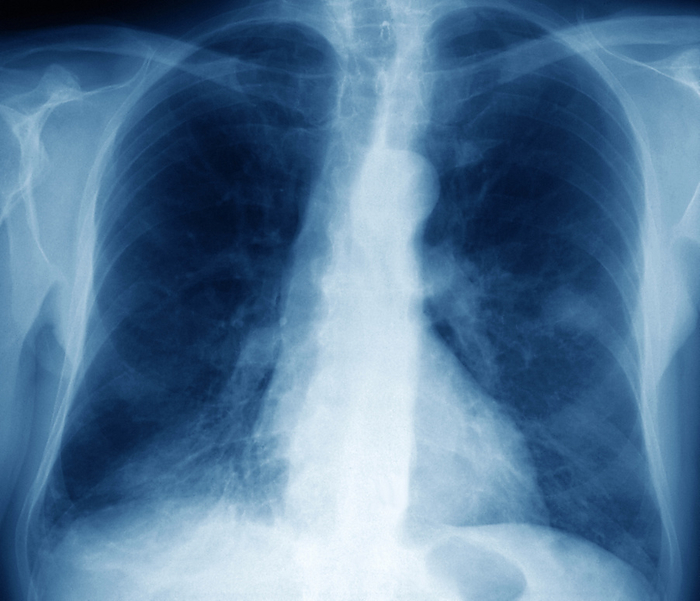 Lung cancer, X ray Lung cancer. Coloured frontal X ray of the lungs of a 72 year old patient with lung cancer. The lungs are the spaces either side of the spine and breast bone  down centre . The heart is at lower centre to lower left. The cancer is in the patient s left lung, and is the round area  white  protruding from the central area at upper centre. This cancer is about 2.5 centimetres in diameter. The main cause of lung cancer is cigarette smoking, but it may also be caused by exposure to certain chemicals, including asbestos. Symptoms include chest pain, shortness of breath and a cough. Treatment is with a combination of chemotherapy and radiotherapy.