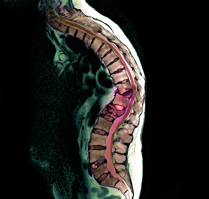 Secondary bone cancer, MRI scan Secondary bone cancer. Coloured magnetic resonance imaging  MRI  scan showing a 70 year old woman with malignant  cancerous  tumours  purple  in her spine. The tumours have metastasised  spread  from a primary cancer of the breast. The cancer has affected the middle back  thoracic vertebrae  and lower back  lumbar vertebrae , as can be seen with the total collapse of the vertebrae at centre  T10, T12 and L1 . This has resulted in the abnormal curvature of the back and pressure on the spinal cord. In this case the patient was rendered wheelchair bound as the condition makes it very difficult to stand upright. Treatment is with a combination of chemotherapy and radiotherapy.