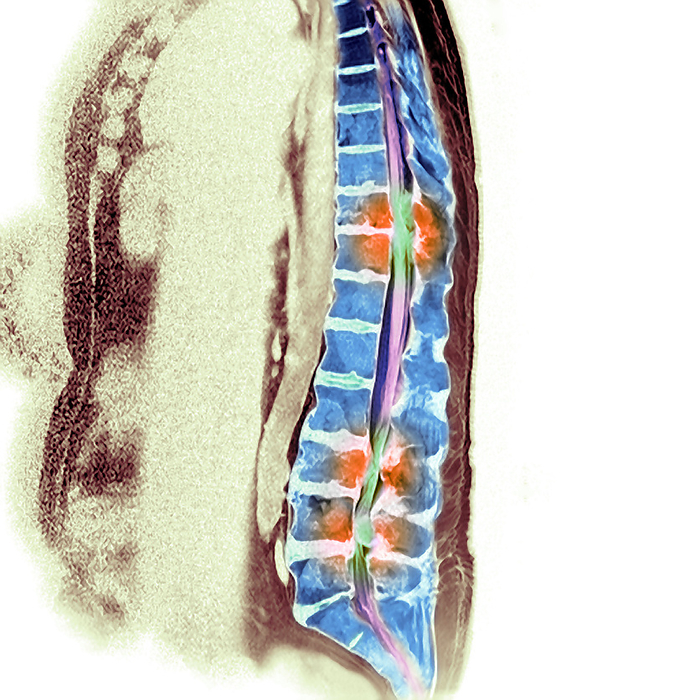 Secondary bone cancer, MRI scan Secondary bone cancer. Coloured magnetic resonance imaging  MRI  scan showing a 57 year old man with malignant  cancerous  tumours  orange  in his spine  blue . The tumours have metastasised  spread  from primary small cell lung cancer. In the middle back  thoracic vertebrae  there is a tumour  orange, upper centre at T10 and T11  surrounding the spinal canal and causing cord compression. Further down there are two other affected sites in the lumbar region. Symptoms are often rapidly progressive and rarely reversible. Prompt diagnosis and decompression by surgery or radiotherapy is the only way to minimise subsequent disability.