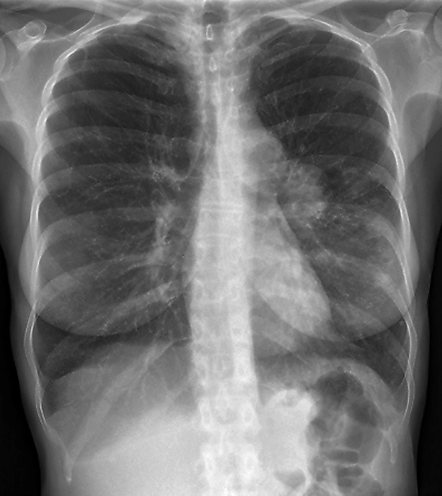 Lung cancer, X ray Lung cancer. X ray showing cancer in the left lung of a 55 year old patient. The cancer is seen here as the grainy region at right of the spine  white column running down centre . The main cause of lung cancer is inhaling cigarette smoke. Symptoms of this type of cancer include chest pain, shortness of breath and a persistent cough. Treatment is with a combination of chemotherapy and radiotherapy.