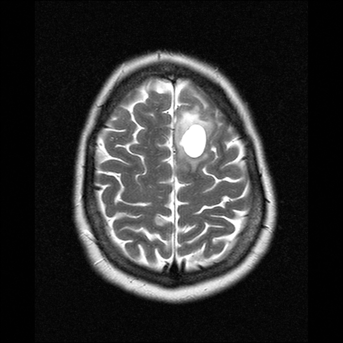 Brain tumour, MRI scan Brain tumour. Magnetic resonance imaging  MRI  scan of an axial  horizontal  section through the head of a 43 year old woman with low grade glioma  white . Glioma, a central nervous system tumour, arises from glial cells. About half of all primary brain tumours are gliomas. Low grade gliomas are slow growing tumours, which are much less likely to come back if they can be completely removed surgically. Radiotherapy may be kept in reserve as a treatment for if the glioma returns. MRI uses radio waves and a magnet to obtain  slice   body images. 