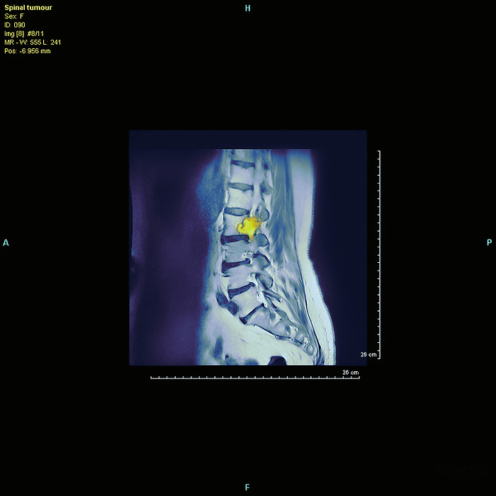 Spine tumour, MRI scan Spine tumour. Coloured magnetic resonance imaging  MRI  scan of the side view of a tumour  yellow  in the spine  backbone  of a female patient. The front of the body is at left. The tumour is located in the lumbar  lower  vertebrae, the blocks of bone that make up the spine and enclose the spinal cord. Spinal tumours are usually secondary cancers that have spread  metastasised  from elsewhere in the body. Prognosis is very poor for secondary cancers, with treatment aimed at preserving function and quality of life. Radiotherapy and steroid drug therapies are most commonly used.