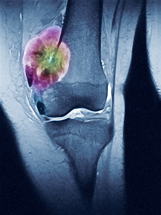 Bone tumour, MRI scan Bone tumour. Coloured magnetic resonance imaging  MRI  scan of the knee of a female patient with a tumour  pink  in the thigh bone  femur . The shin bone  tibia  is at bottom. This type of tumour can be malignant  cancerous  or benign  non cancerous . Examples of malignant bone tumours include osteosarcoma, chondrosarcoma and Ewing s sarcoma. Benign bone tumours include osteoma, osteochondroma and fibrous dysplasia. Sometimes, the tumour is a secondary bone tumour, where cancerous tumours have metastasised  spread  to the bone from elsewhere in the body. Treatment depends on the type of tumour, but usually includes surgery to remove the affected bone  such as amputation in severe cases , radiotherapy and chemotherapy.