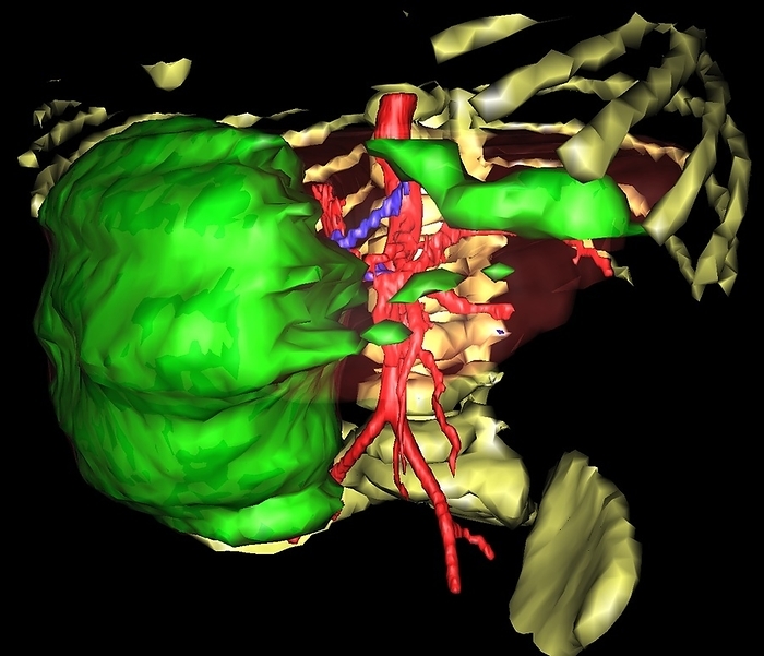 Primary liver cancer, 3D MRI scan Primary liver cancer. 3D magnetic resonance imaging  MRI  scan of a primary cancer  green  in the liver of a 3 year old child, seen from below. This cancer has spread beyond the liver. The bones of the ribcage and spine  yellow , and the central blood vessels  red  are also shown. This is an advanced scanning program that can distinguish different tissues in a level of detail high enough to detect small, local tumours, as well as larger ones. This scan was produced at IRCAD, the French research institute for digestive system cancers, in Strasbourg, France.