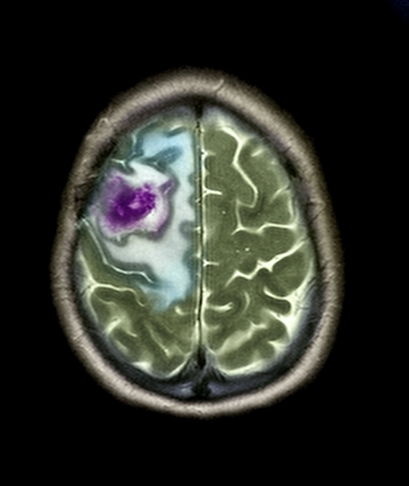 Secondary brain cancer, MRI scan Secondary brain cancer. Coloured magnetic resonance imaging  MRI  scan of an axial  horizontal  section through the head of a 42 year old man, showing a brain tumour  purple  of the right frontal lobe. The front of the head is at top. This is a secondary cancer that has spread  metastasised  from a carcinoma of the lung. Tumours put pressure on the brain, causing a range of symptoms, such as headaches, seizures and vomiting. Treatment is with surgery to remove the tumour, or radiotherapy or immunotherapy to reduce its size.