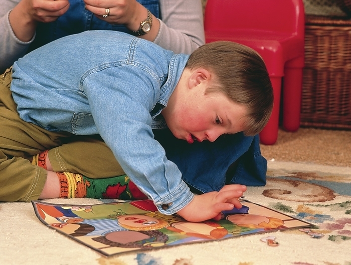 7 year old boy with Down s syndrome playing a game Down s syndrome. A seven year old boy with Down s syndrome, also known as trisomy 21, playing a game. Down s syndrome results from a chromosomal abnormality  each body cell contains an extra chromosome  number 21  so that there are 47 chromosomes rather than the usual 46. This results in a variable mental handicap  IQ usually lies between 30 and 80  almost all affected children have learning potential , and distinctive appearance with upward sloping eyes. Heart defects, congenital deafness and leukaemia are more common in people with Down s syndrome. About one in 650 babies shows this abnormality   this rate increases with increased maternal age.