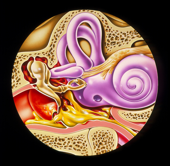 Illustration showing otitis media in middle ear Otitis media. Illustration showing the area of the middle ear affected by otitis media. Otitis media is inflammation of the middle ear due to an infection in the eustachian tube  lower right  which joins the middle ear to the nasal cavity. The infection causes blockage of the tube, and a build up of pus  yellow  occurs behind the eardrum  red, lower left . This causes ear pain   impaired hearing. The infection can usually be cleared up with antibiotics. Also see is the cochlea  purple, centre right  which detects sound, and the stapes, incus and malleus ear bones  light brown, centre left . Semicircular canals  purple, upper centre  control balance.
