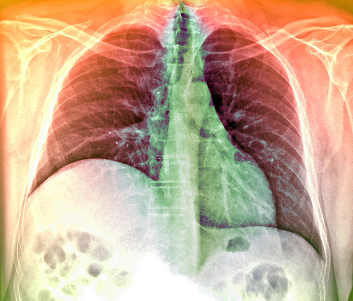Enlarged liver, X ray Enlarged liver. Coloured X ray of the chest of a 55 year old patient with an enlarged liver  hepatomegaly . The liver itself cannot be seen, but the disorder has been revealed by the raised diaphragm  white, lower left . An enlarged liver is usually a symptom of an underlying cause, such as cancer, high blood pressure  hypertension  or infection. Treatment is of the cause, and liver transplant surgery may be needed in severe cases.