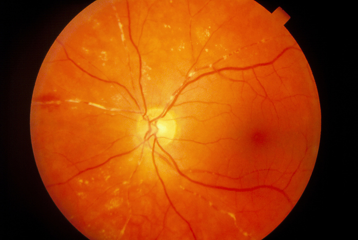 Ophthalmoscopy of retinal embolism in patient eye Retinal embolism. Ophthalmoscopy view of the retina of the eye, showing cholesterol embolism. Retinal embolism  also called occlusion  is the blockage of blood vessels to the retina, in this case by excessive cholesterol particles in the bloodstream. Red blood vessels are seen branching from the optic disc  yellow, at centre , many with white cholesterol emboli obstructing blood flow. This has lead to haemorrhage  bleeding  seen as diffuse red areas  at far left . White spots throughout the image are also signs of blood vessel disease. If major arteries within the eye are affected, the result is immediate sight loss.