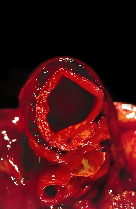Dissecting aneurysm Dissecting aneurysm. Gross specimen of a section through a dissecting aneurysm of the aorta  round, centre . This is where the layers of the wall of an artery split or dissect. Blood flows into the gap  dark blood clots  between the inner  bright red  and outer wall. The aorta is the major artery carrying blood from the heart to most parts of the body. If an aneurysm ruptures, massive internal bleeding may result in death. It can be surgically repaired by reinforcing the wall of the artery, but an aneurysm can develop with no or few symptoms.