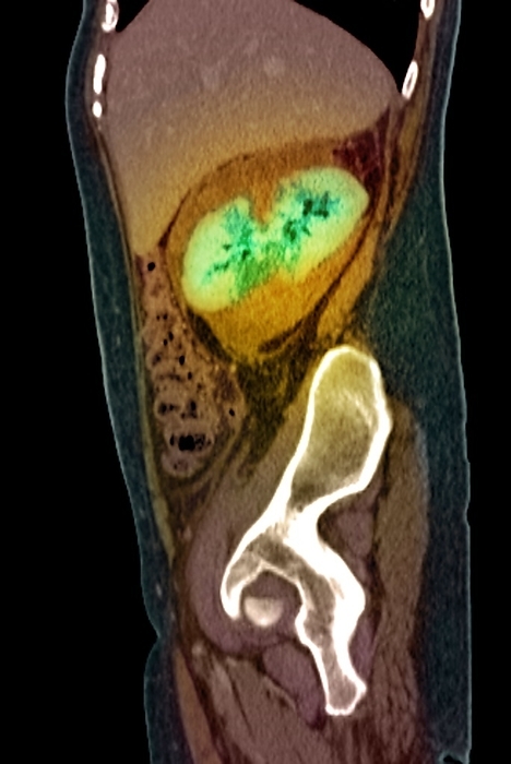 Kidney damage, CT scan Kidney damage. Coloured lateral computed tomography  CT  scan showing a vertical section through the abdomen of a woman who has been in a traffic accident. The front of the body is at left and the liver can be seen at top  solid mass . The patient s right kidney  green, upper centre  has been lacerated, causing it to haemorrhage  bleed  and become displaced downward. Lacerations are irregular, tear like wounds caused by some form of blunt trauma. Kidney lacerations are also common injuries associated with contact sports.
