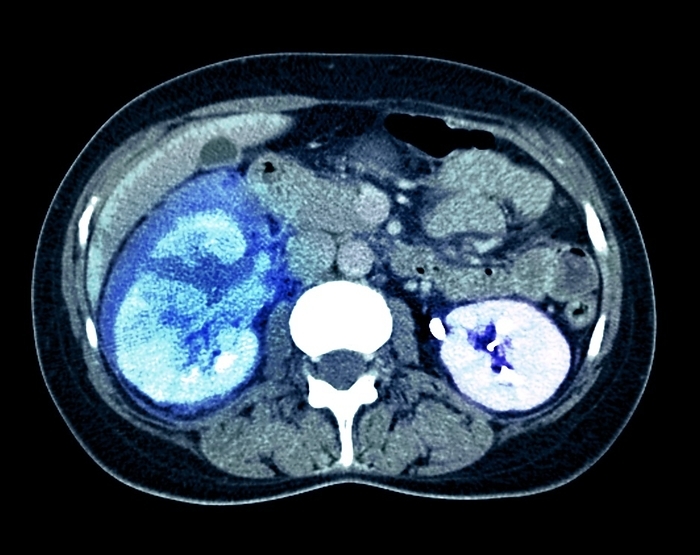 Kidney damage, CT scan Kidney damage, coloured computed tomography  CT  scan. Scan from below, showing a horizontal section through the abdomen of a woman who has been in a traffic accident. The front of the body is at top and the spine can be seen below  solid white . The patient s right kidney  blue, left  has been lacerated, causing it to haemorrhage  bleed  and become displaced downward. Lacerations are irregular, tear like wounds caused by some form of blunt trauma. Kidney lacerations are also common injuries associated with contact sports.