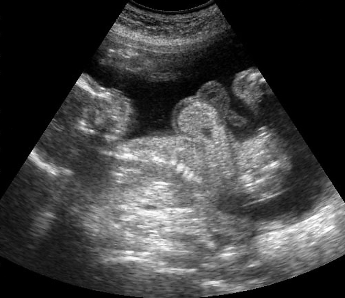 Foetus with oedema, ultrasound scan Foetus with an oedema. Ultrasound scan of a foetus with a subcutaneous oedema. This buildup of fluid in the subcutaneous tissue  under the top skin layer  can cause miscarriages and is often a sign of underlying disorders such as hydrops fetalis  a type of prenatal heart failure . Ultrasound scanning is a diagnostic technique that sends high frequency sound waves into the body via a transducer. The returning echoes are recorded and used to build an image of an internal structure.