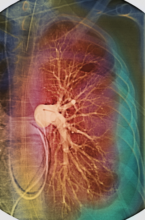 Pleural effusion, X ray Pleural effusion. Coloured X ray angiogram of lung blood vessels  branching, light coloured  and a pleural efflusion. The pleural efflusion is seen as a thin vertical line at lower left, bisecting the loop that is the catheter injecting a contrast medium into the lung blood vessels. The line marks the abnormal presence of fluid in the chest lung compartment  pleural cavity . Excessive build up of fluid will cause compression of the lung and breathing difficulties. The condition may occur in pneumonia, heart failure and cancer. The fluid may need to be surgically drained. The surrounding ribs  green blue  and spine  left  are seen.