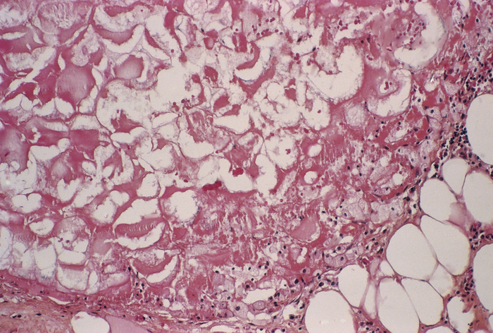 Fat necrosis of pancreas Fat necrosis of pancreas. Light micrograph of a setion through a pancreas showing fat necrosis  steatonecrosis, white areas . This is a condition where the body s enzymes break down fats from adipose tissue into fatty acids and glycerol. The fatty acids react to form soap like compounds. It occurs in the pancreas during acute haemorrhagic pancreatitis, when enzymes that are normally secreted by the pancreas become activated too soon and begin to digest its tissues. Risk factors include alcohol abuse, gallbladder disease, infection, injury and some medications. Magnification unknown.